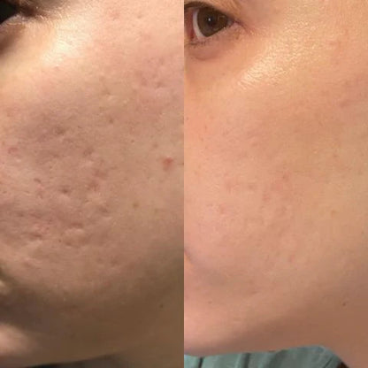 HoneyPeel™ - 
Silicone Scar Sheets